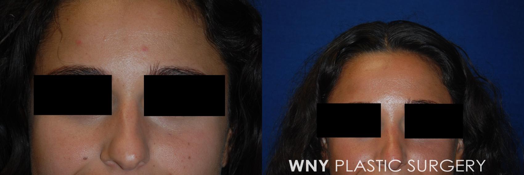 Before & After Rhinoplasty Case 156 View #1 View in Williamsville, NY