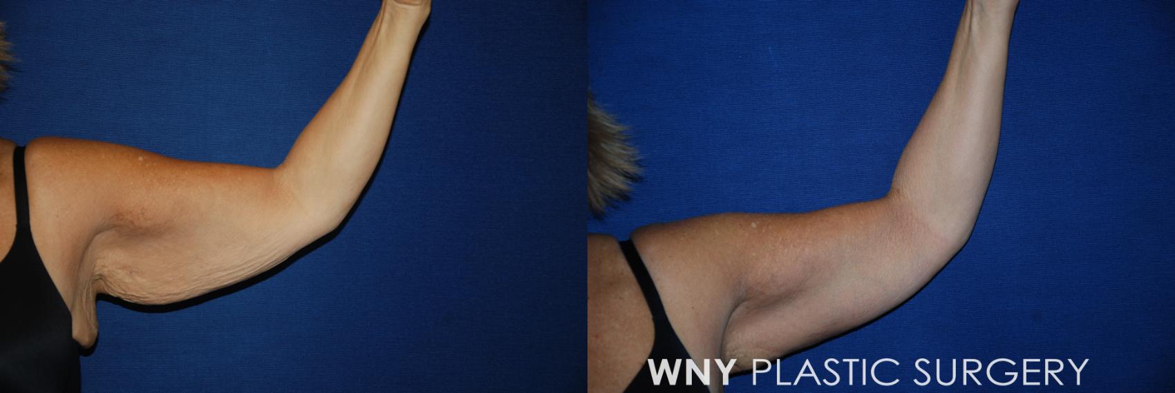 Before & After Arm Lift Case 112 View #1 View in Williamsville, NY