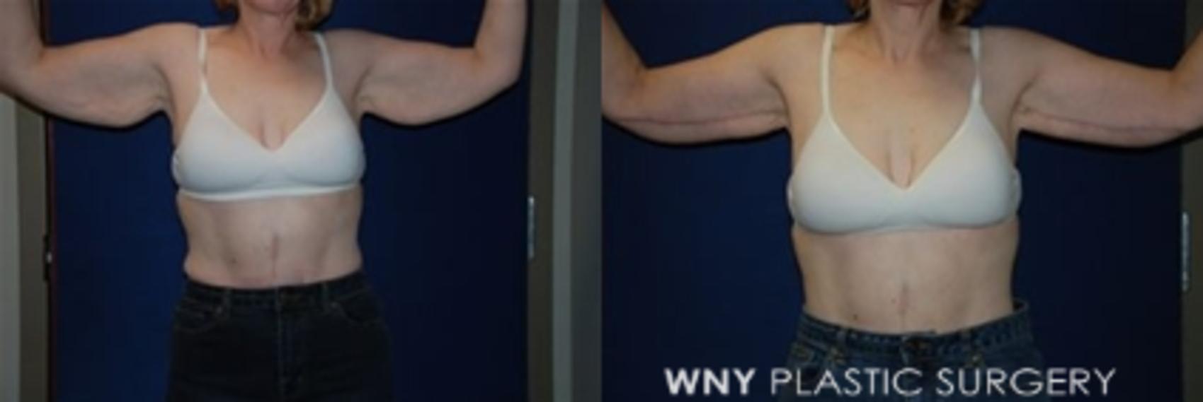 Before & After Arm Lift Case 4 View #1 View in Williamsville, NY