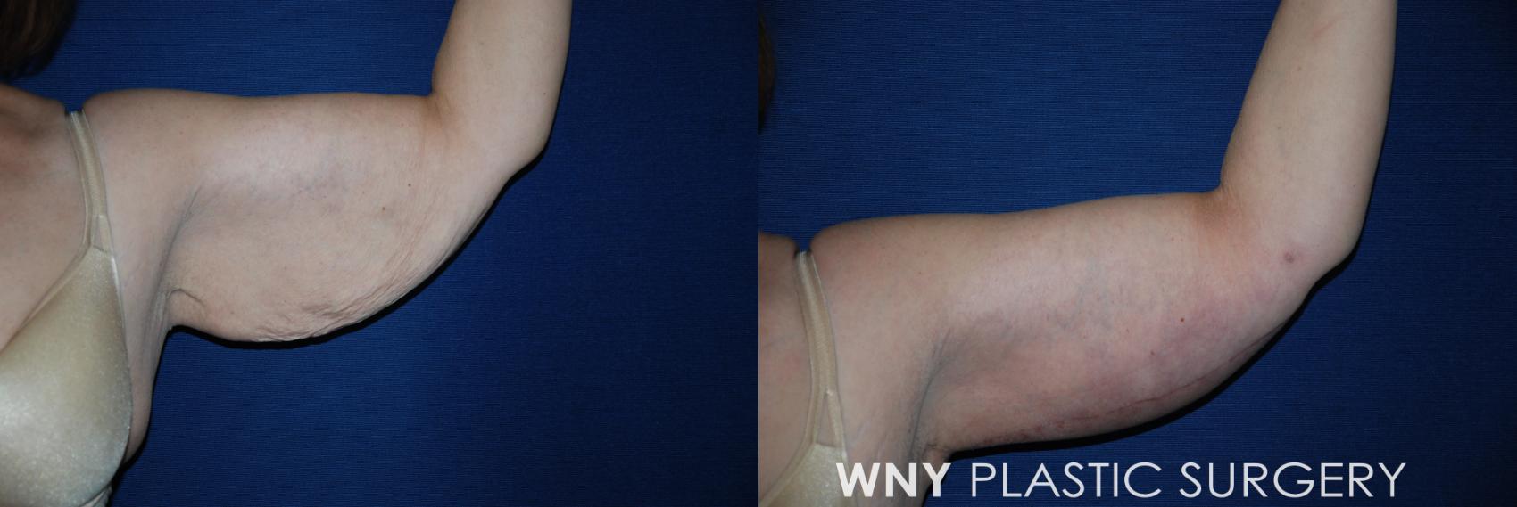 Before & After Arm Lift Case 58 View #1 View in Williamsville, NY