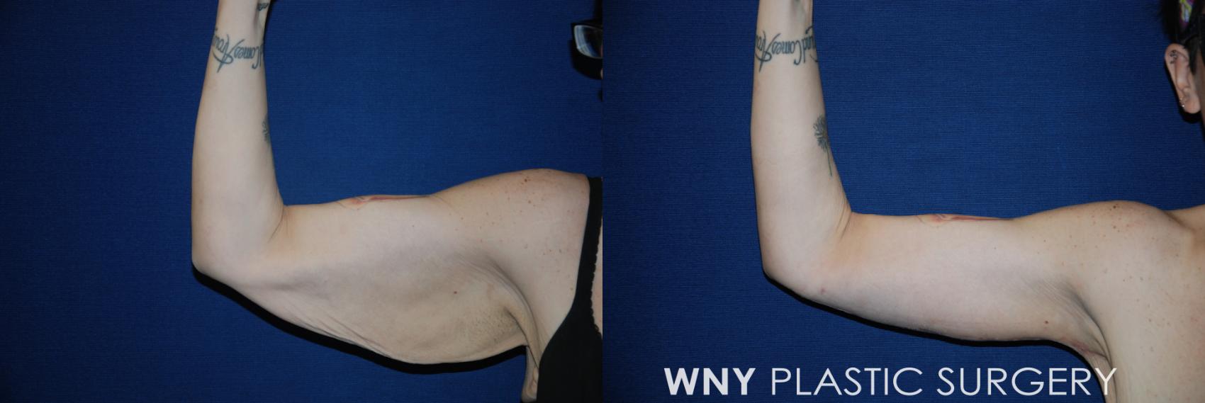 Before & After Arm Lift Case 80 View #1 View in Williamsville, NY