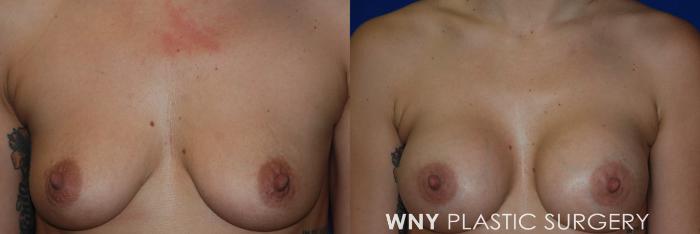 Before & After Breast Augmentation Case 100 View #1 View in Williamsville, NY