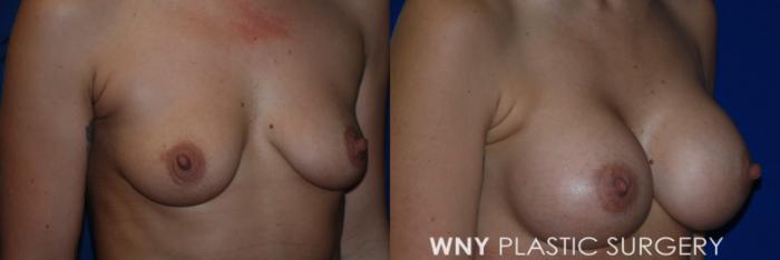 Before & After Breast Augmentation Case 100 View #2 View in Buffalo, NY