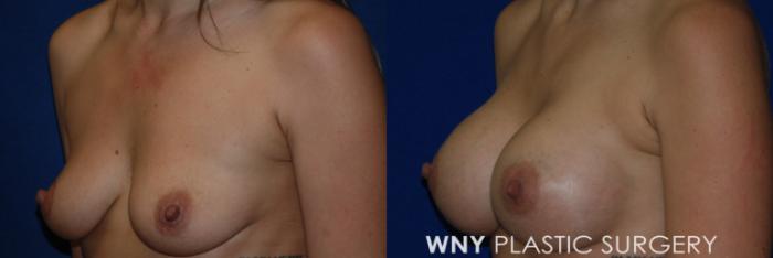 Before & After Breast Augmentation Case 100 View #3 View in Buffalo, NY
