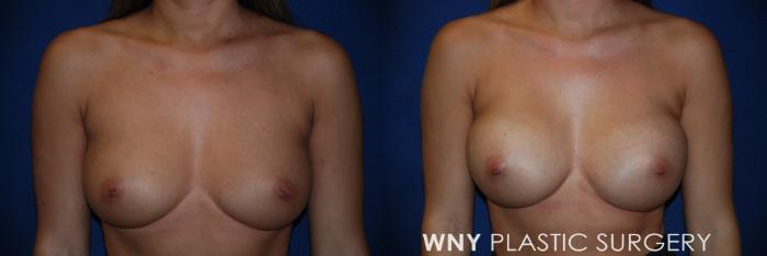 Before & After Breast Augmentation Case 109 View #1 View in Buffalo, NY