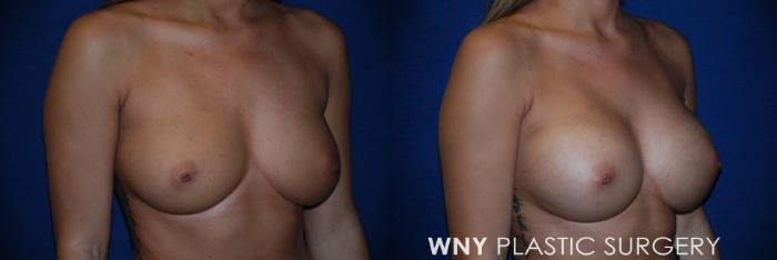 Before & After Breast Augmentation Case 109 View #2 View in Buffalo, NY