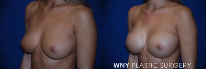 Before & After Breast Augmentation Case 109 View #3 View in Buffalo, NY