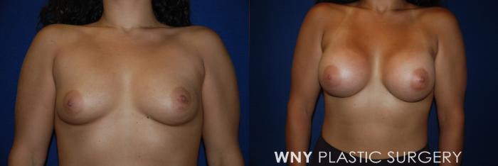 Before & After Breast Augmentation Case 154 View #1 View in Buffalo, NY