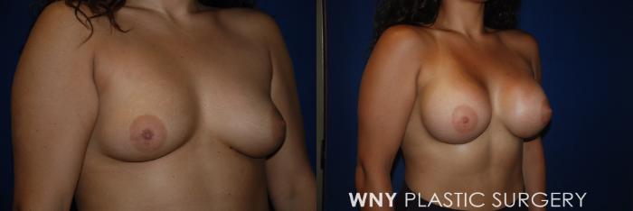 Before & After Breast Augmentation Case 154 View #2 View in Buffalo, NY