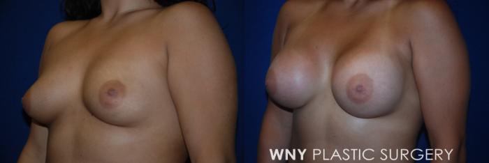 Before & After Breast Augmentation Case 154 View #3 View in Buffalo, NY