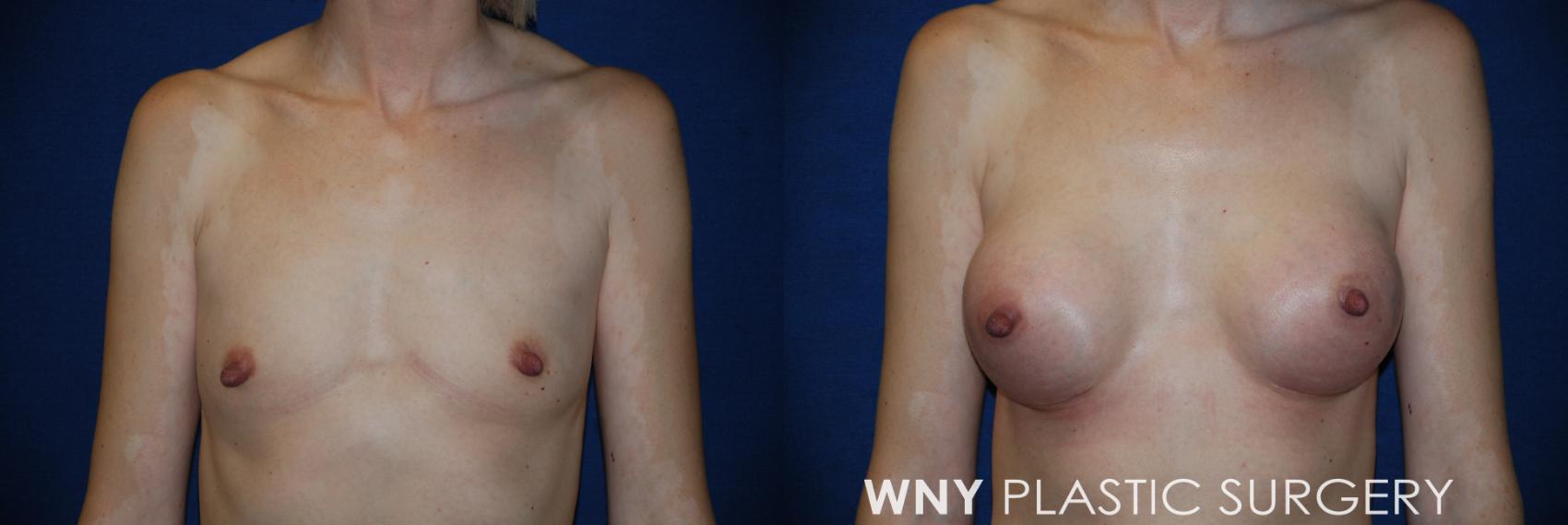 Before & After Breast Augmentation Case 163 View #1 View in Buffalo, NY