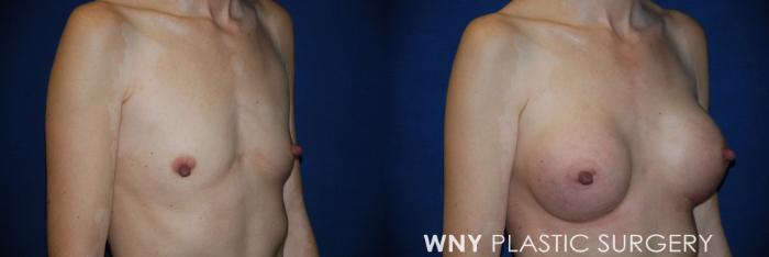 Before & After Breast Augmentation Case 163 View #2 View in Buffalo, NY