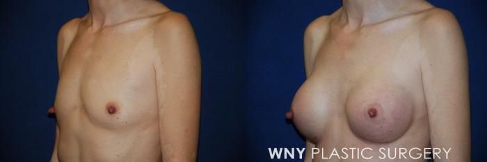 Before & After Breast Augmentation Case 163 View #3 View in Buffalo, NY