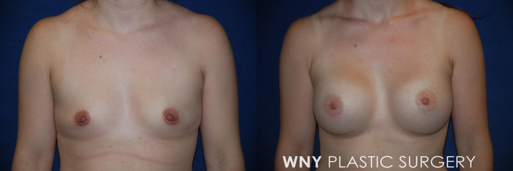 Before & After Breast Augmentation Case 165 View #1 View in Williamsville, NY