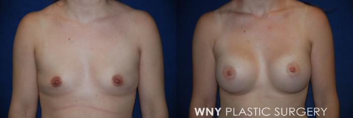 Before & After Breast Augmentation Case 165 View #1 View in Buffalo, NY