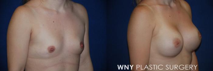 Before & After Breast Augmentation Case 165 View #2 View in Buffalo, NY