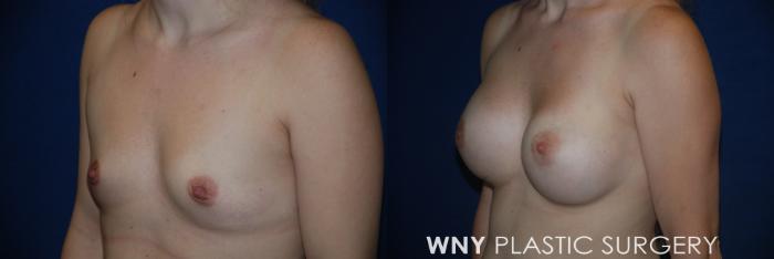 Before & After Breast Augmentation Case 165 View #3 View in Buffalo, NY