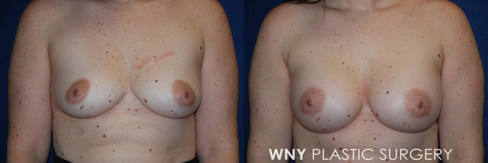 Before & After Breast Augmentation Case 171 Front View in Williamsville, NY