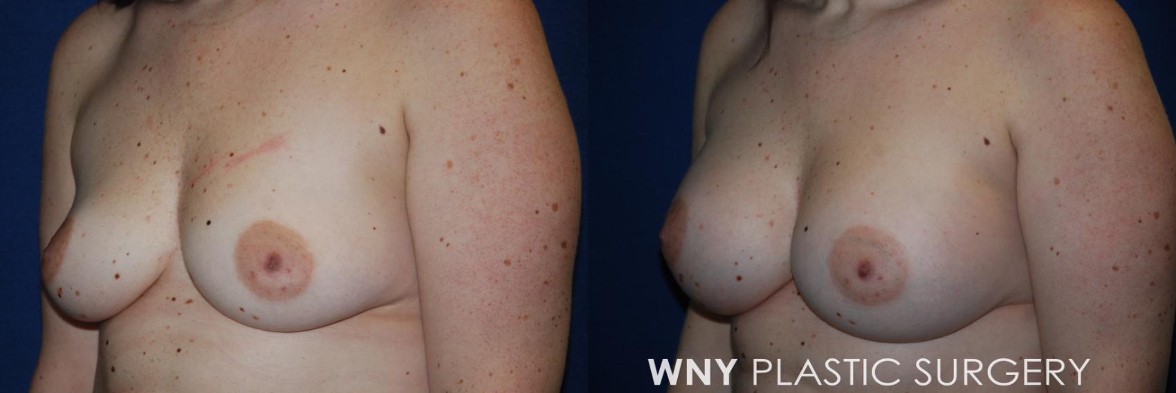 Before & After Breast Augmentation Case 171 Left Side View in Williamsville, NY