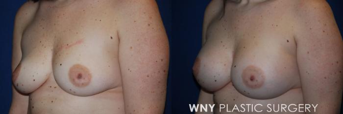 Before & After Breast Augmentation Case 171 Left Side View in Williamsville, NY