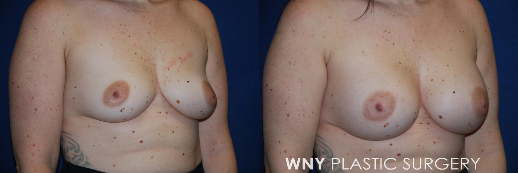 Before & After Breast Augmentation Case 171 Right Side View in Williamsville, NY