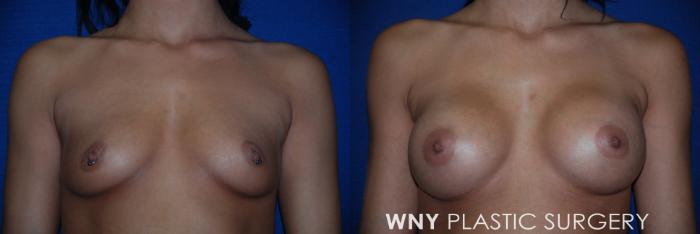 Before & After Breast Augmentation Case 19 View #1 View in Williamsville, NY