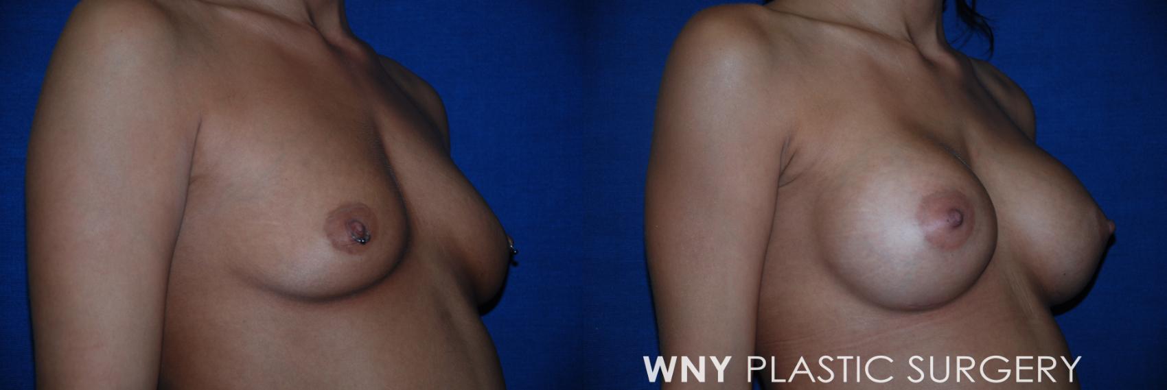 Before & After Breast Augmentation Case 19 View #2 View in Williamsville, NY