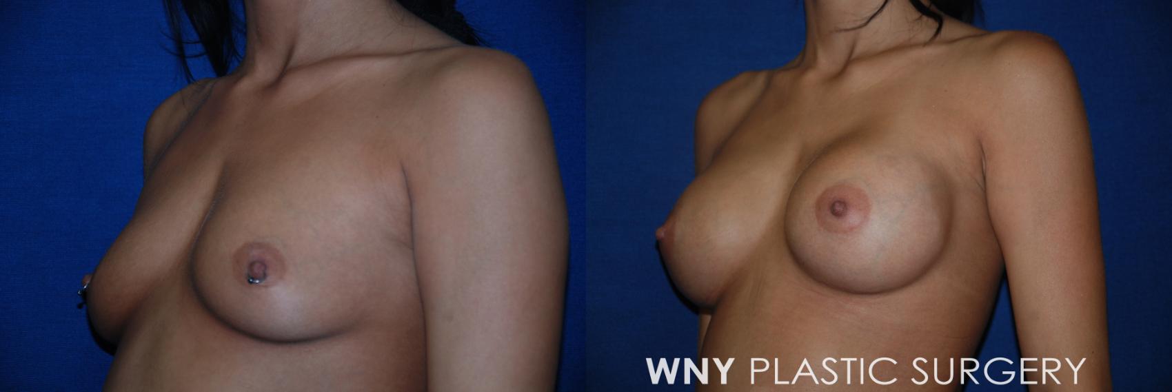 Before & After Breast Augmentation Case 19 View #3 View in Williamsville, NY