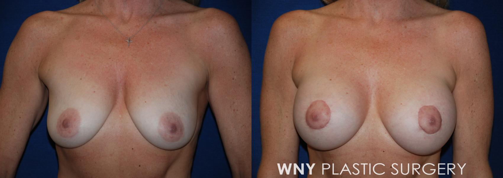 Before & After Breast Augmentation Case 194 Front View in Williamsville, NY