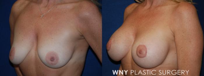 Before & After Breast Lift Case 194 Left Oblique View in Buffalo, NY