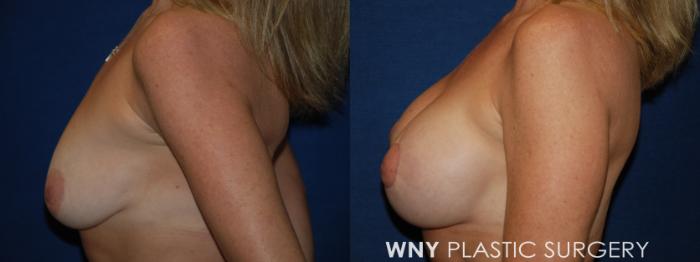 Before & After Breast Augmentation Case 194 Left Side View in Williamsville, NY