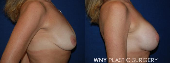 Before & After Breast Augmentation Case 194 Right Side View in Williamsville, NY