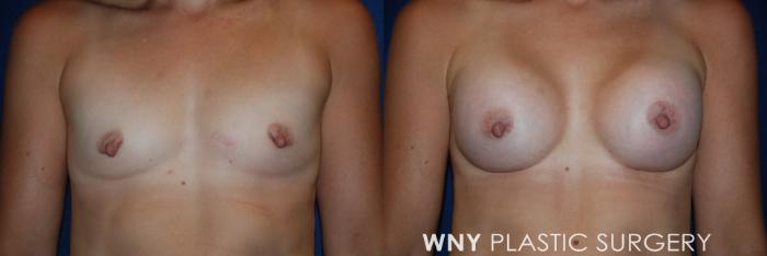 Before & After Breast Augmentation Case 203 Front View in Buffalo, NY