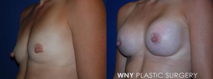 Before & After Breast Augmentation Case 203 Left Oblique View in Buffalo, NY