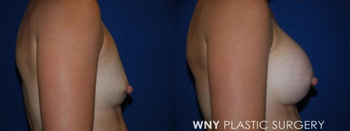 Before & After Breast Augmentation Case 203 Left Side View in Buffalo, NY