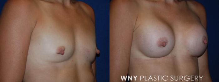 Before & After Breast Augmentation Case 203 Right Oblique View in Buffalo, NY