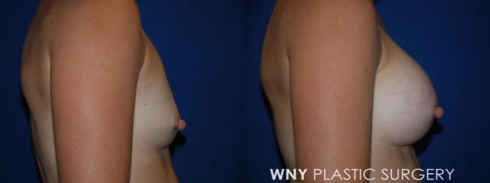 Before & After Breast Augmentation Case 203 Right Side View in Buffalo, NY