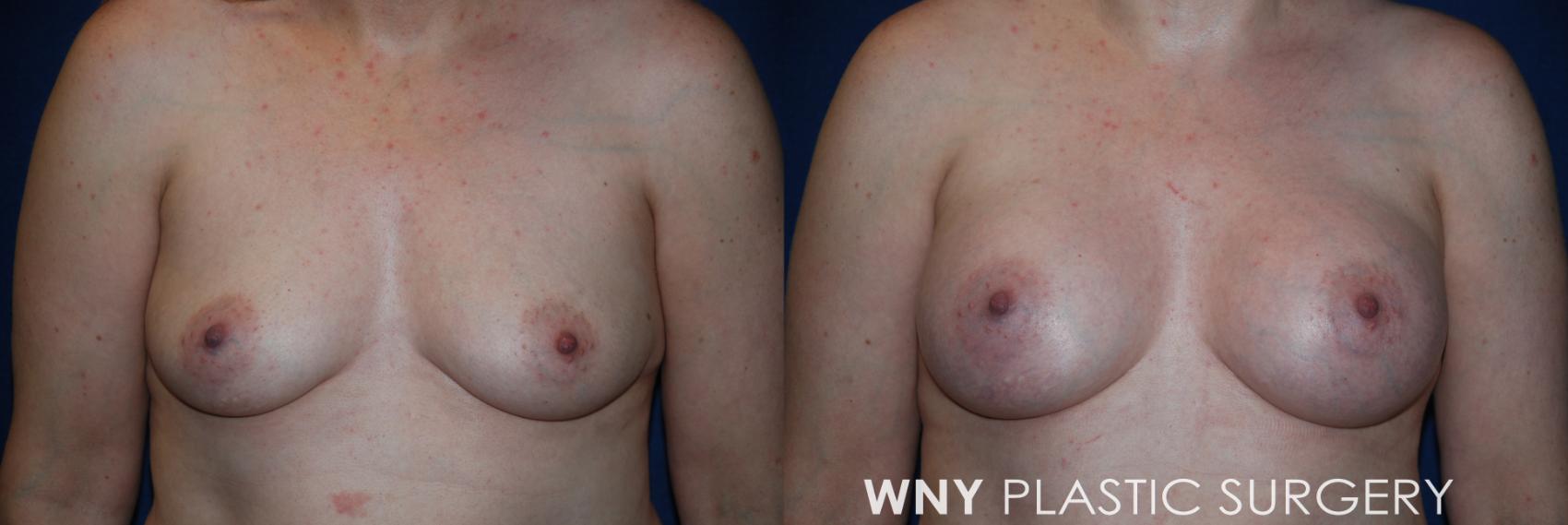 Before & After Breast Augmentation Case 204 Front View in Williamsville, NY