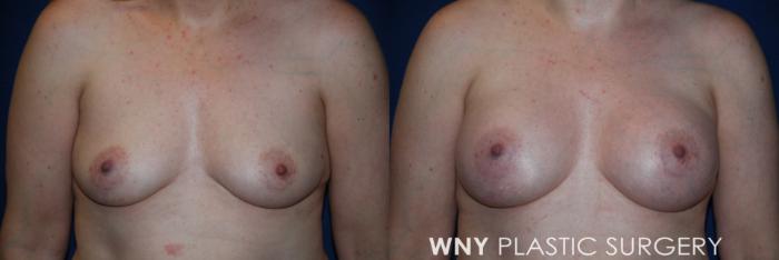 Before & After Breast Augmentation Case 204 Front View in Williamsville, NY