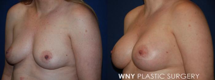 Before & After Breast Augmentation Case 204 Left Oblique View in Buffalo, NY