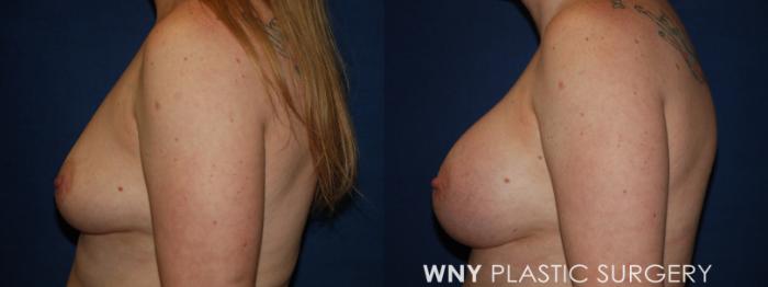 Before & After Breast Augmentation Case 204 Left Side View in Buffalo, NY