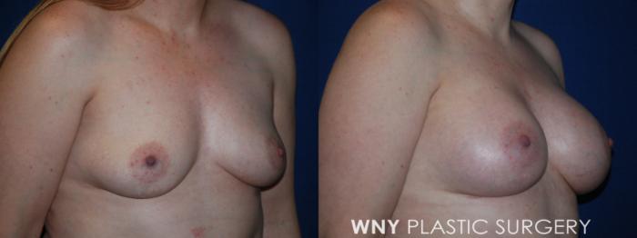 Before & After Breast Augmentation Case 204 Right Oblique View in Buffalo, NY