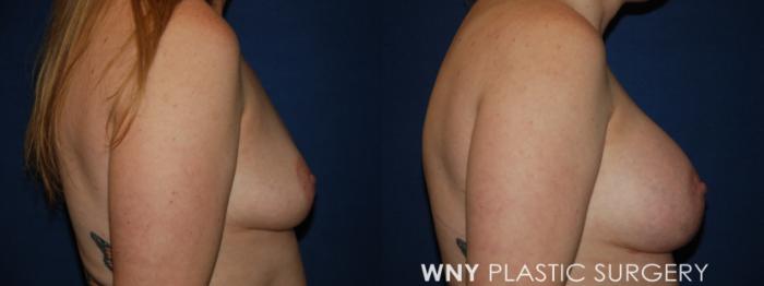 Before & After Breast Augmentation Case 204 Right Side View in Buffalo, NY