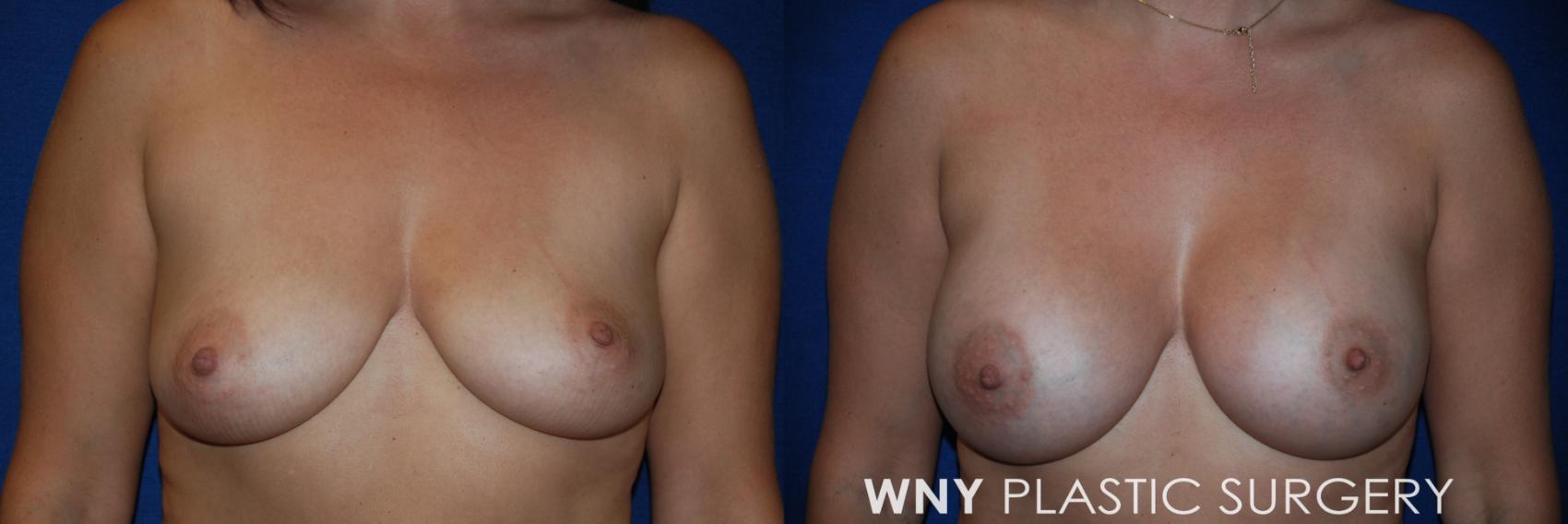 Before & After Breast Augmentation Case 209 Front View in Williamsville, NY