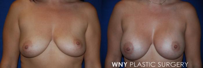 Before & After Breast Augmentation Case 209 Front View in Buffalo, NY