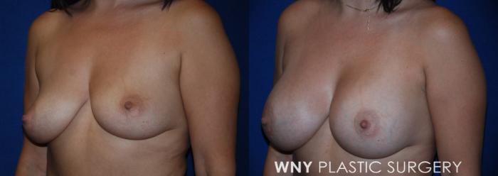 Before & After Breast Augmentation Case 209 Left Oblique View in Buffalo, NY