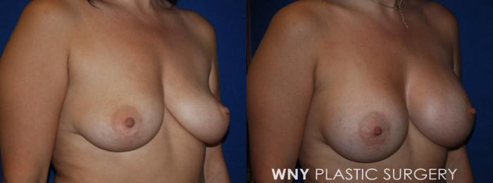 Before & After Breast Augmentation Case 209 Right Oblique View in Buffalo, NY