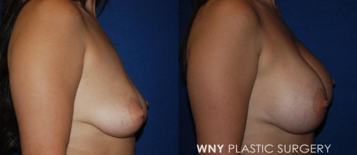 Before & After Breast Augmentation Case 209 Right Side View in Buffalo, NY