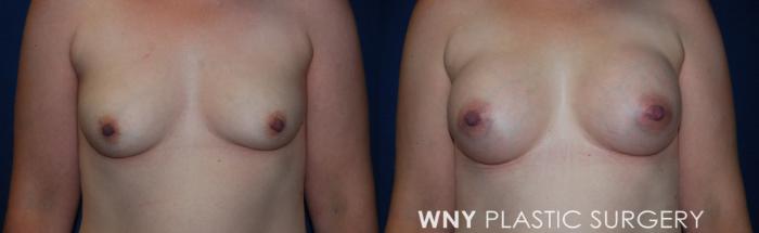 Before & After Breast Augmentation Case 210 Front View in Buffalo, NY