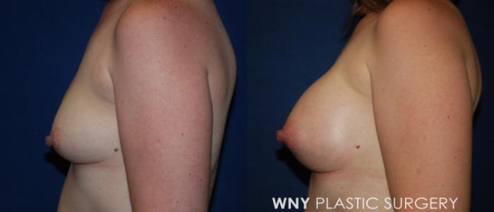 Before & After Breast Augmentation Case 210 Left Side View in Buffalo, NY